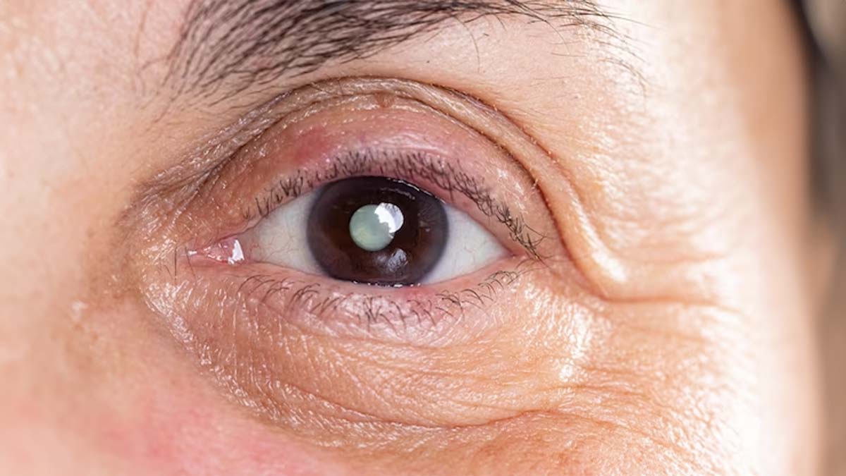 Ayurvedic understanding and integrative management of Adhimantha with correlation to glaucoma